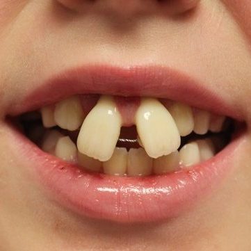 Patient Warning: Do Not Attempt DIY Teeth Straightening