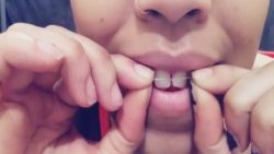 using rubber bands to straighten teeth