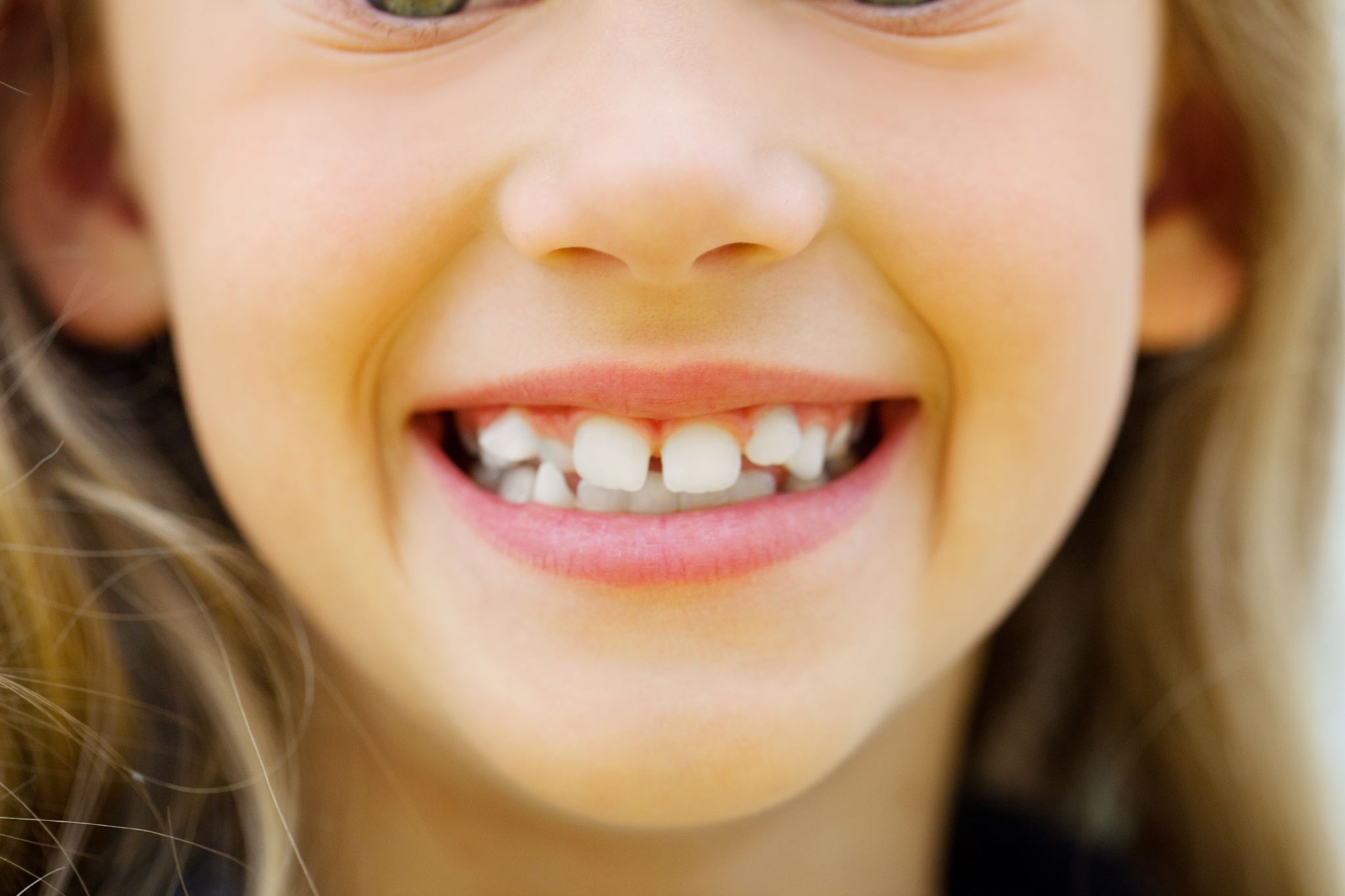 Why Do We Get Crooked Teeth?