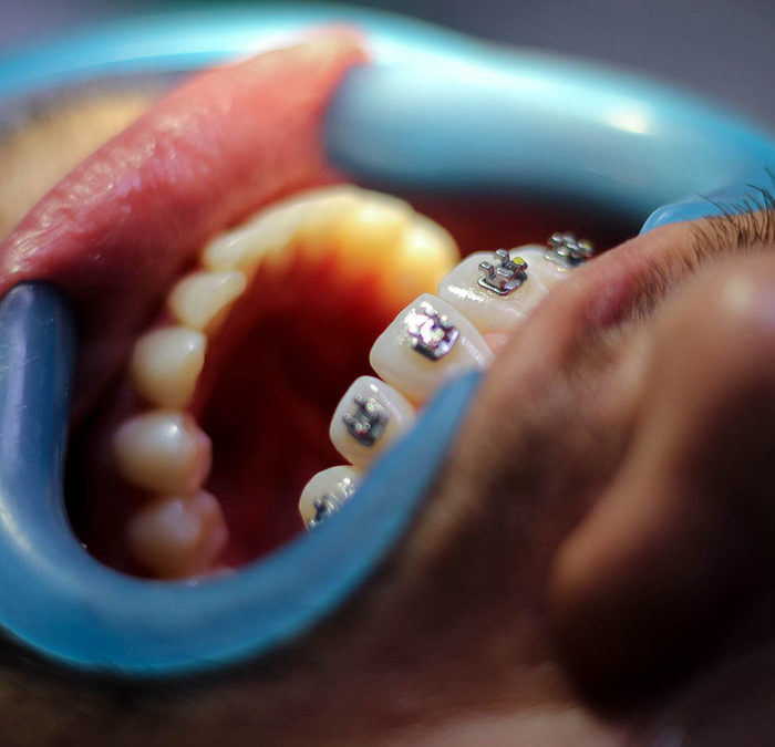 Preparing for Orthodontic Emergencies