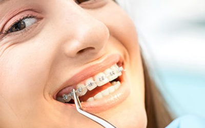 Do I Need Braces? Tell-Tale Signs It’s Time for Orthodontic Treatment