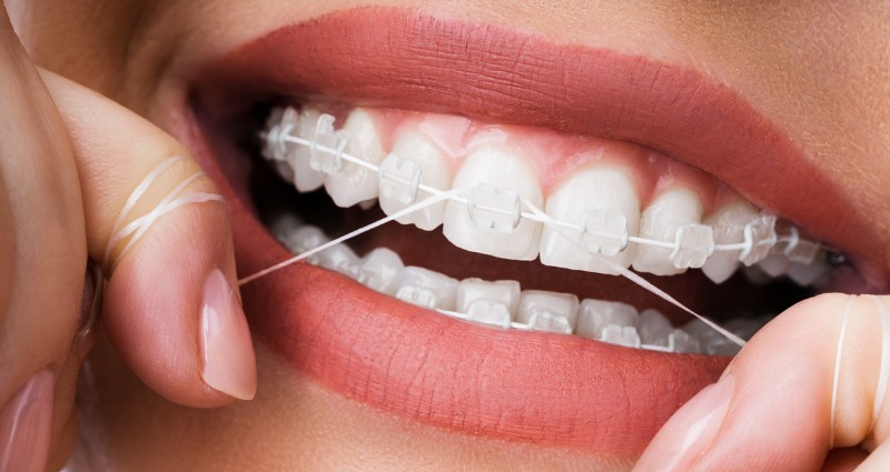 Flossing with Braces – How to Floss When you Have Braces