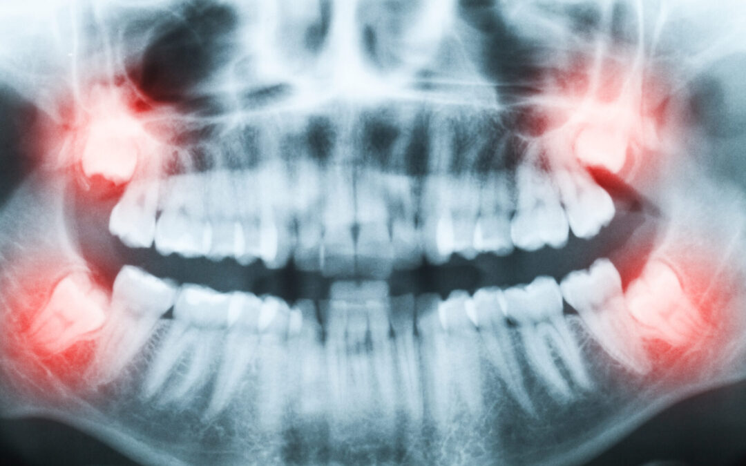 Are Wisdom Teeth Genetic?