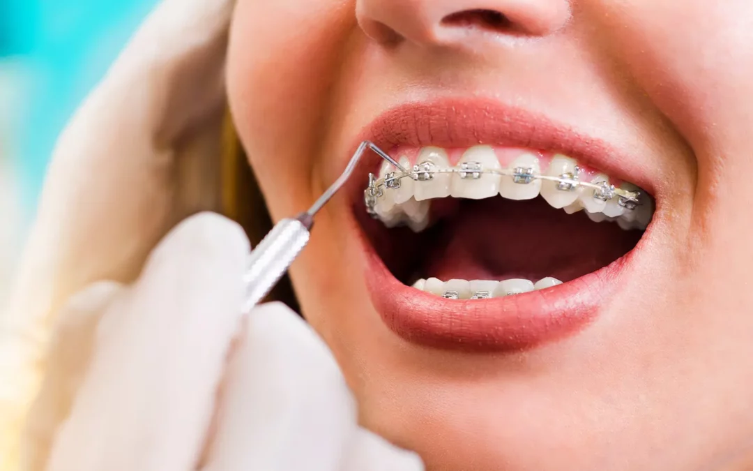 Foods You Should Eat and Avoid with Braces: A Guide from Our Orthodontists