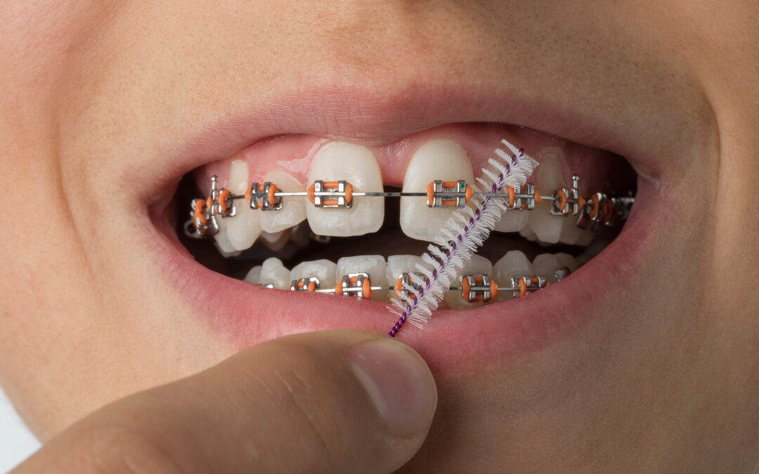 Orthodontic Care and Maintenance